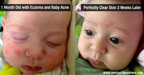 Another Amazing Before After Of Baby Eczema From Emily Skin Soothers