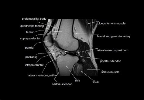 Mri for evaluating knee pain in older patients: mri knee anatomy | knee sagittal anatomy | free cross sectional anatomy