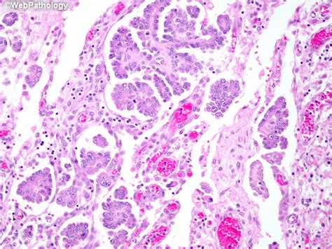 Mesothelioma of the peritoneum is a fairly rare form of malignant neoplasms affecting peritoneal tissues. Webpathology.com: A Collection of Surgical Pathology Images