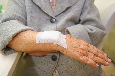 Understanding Elderly Skin Bruising A Place For Mom
