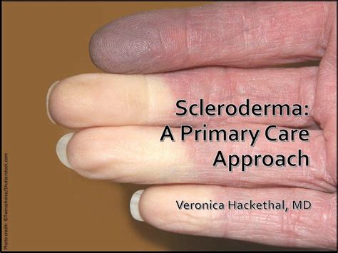 Scleroderma A Primary Care Approach