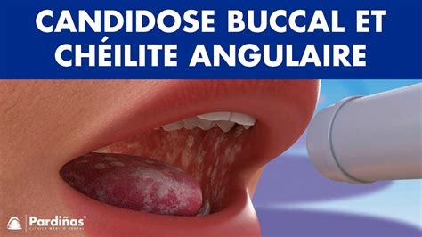 Candidose Buccal Muguet Et Ch Ilite Angulaire Champignon Dans La