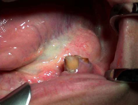 Giant Salivary Gland Calculi Gsgc Report Of Two Cases Fulltext