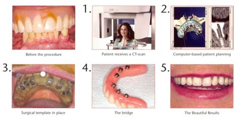 Implant Dentist in West Houston, TX | Dr. Tomy Nguyen