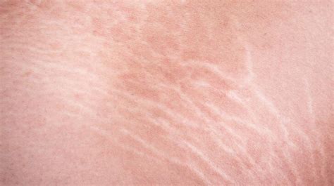 9 Things To Know About Stretch Marks Causes And Treatments