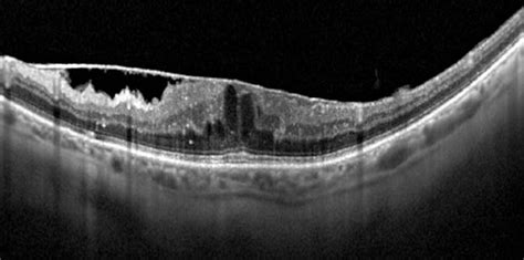 Macular Pucker Retina Associates Of Greater Philadelphia