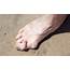 Hammertoe  HyProCure The Proven Solution To Misaligned Feet