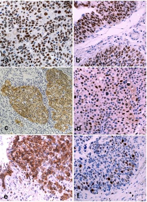 The Representative Immunohistochemical Staining Of Molecular Markers In