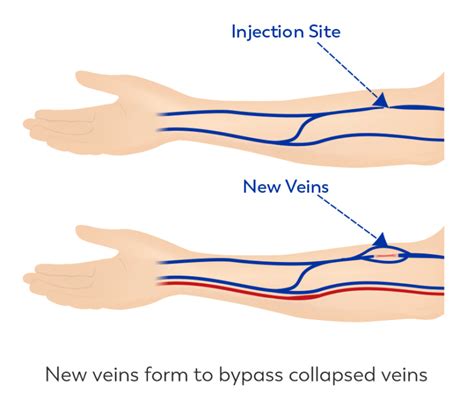 What Is A Collapsed Vein Ask Our Doctors By Journeypure