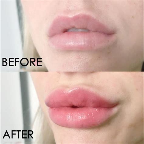 Collagen Lips Before After