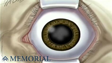 Cataract Small Incision Surgery Youtube