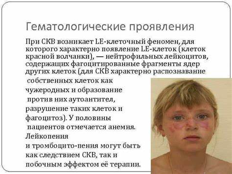 Диета при системная красная волчанка Заболевание Системная Красная Волчанка — Buy-artox.ru Заболевание Системная Красная Волчанка — Buy-artox.ru Диета при системная красная волчанка