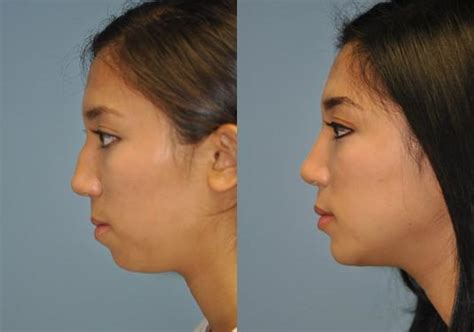 Chin And Facial Implant Photos Chevy Chase Md Patient 8929