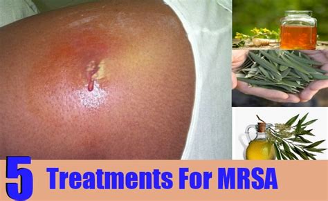 5 Effective Treatments For Mrsa Natural Home Remedies And Supplements