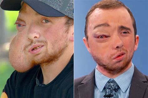 Man Who Had 8 Lb Facial Tumor Removed Says Hes Finally Pain Free It