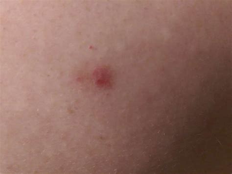 Basal Cell Carcinoma Basalioma Pictures Cancer Photos Dermatology