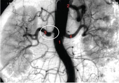 Angiography For Renal Artery Diseases Intechopen