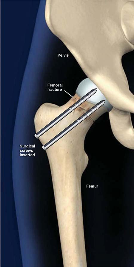 Hip Fracture Treatment With Surgical Screws Central Coast Orthopedic Medical Group