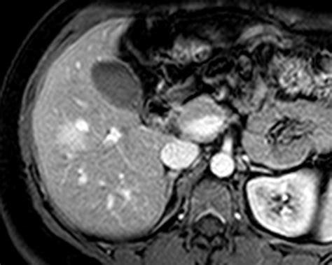 Liver Atlas Case 204 Focal Nodular Hyperplasia Fnh Typical Small