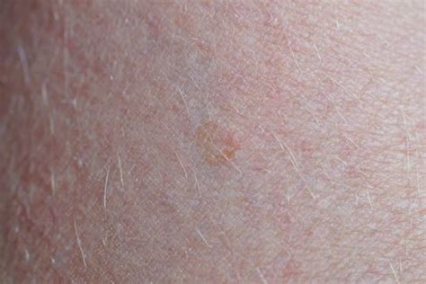 330 Basal Cell Carcinoma Stock Photos Pictures And Royalty Free Images