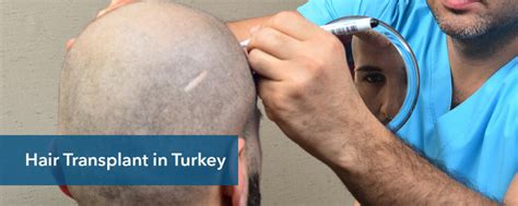 Hair Transplant For Women In Turkey Female Hair Transplant Turkey Cost