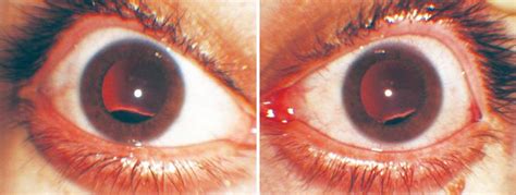 Scielo Brasil Bilateral Isolated Lens Coloboma Associated With