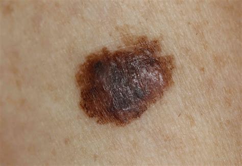 Skin Cancer Signs Symptoms And Complications