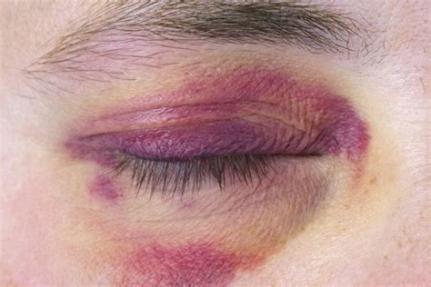 The Causes And Treatment Of Black Eye The Eye News