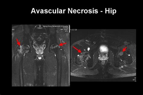 Avascular necrosis of the hip: Suffering from Avascular Necrosis Hip? It is a pretty ...