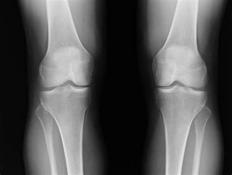 Meniscal Injury Knee Sports Orthobullets