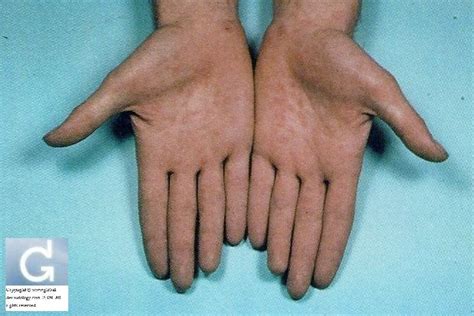 Syphilis Rash On Hands