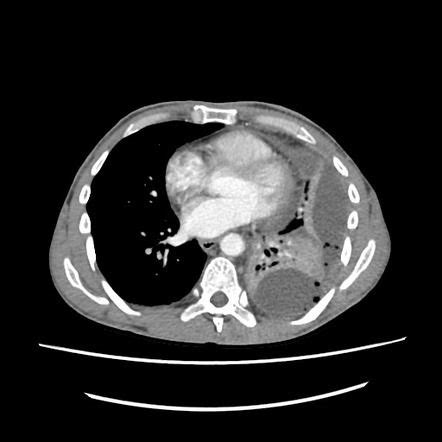 Obliteration of left costophrenic angle with a wide pleural based dome shaped opacity projecting into. Thoracic empyema | Radiology Reference Article ...