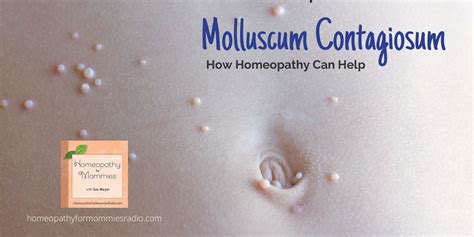 Molluscum Contagiosum How Homeopathy Can Help Ultimate Homeschool