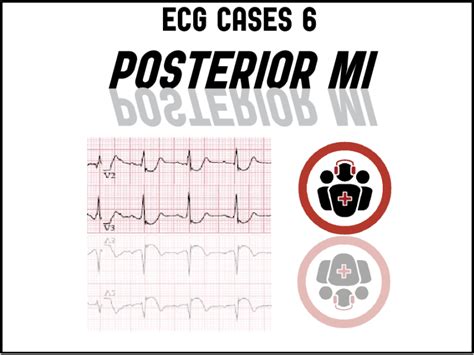 Posterior Mi Ecg Cases 6 Emergency Medicine Cases