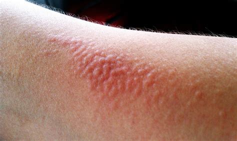 Skin Rashes In Children On Face In Adults On Hands On Arms That Itch In