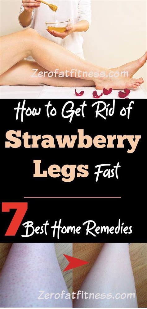 How To Get Rid Of Strawberry Legs Fast 7 Best Home Remedies