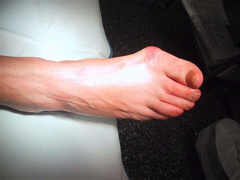 How To Prevent A Bunion From Getting Worse Bunions When T Flickr