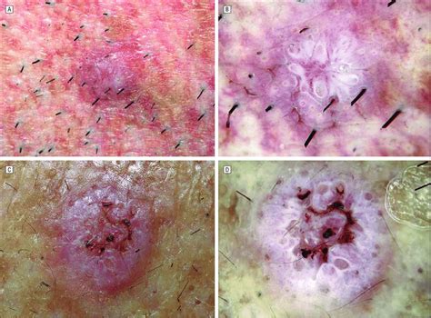 White Circles In Squamous Cell Carcinoma Clinical A And C And