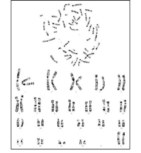 Karyotype Normal Female High Resolution Karyotyping In A Case Of Our
