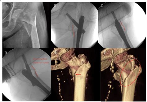 An 84 Years Old Female With Pertrochanteric Femur Fracture