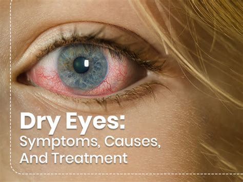 Dry Eyes Symptoms Causes Risk Factors Treatment And Prevention