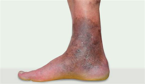 Home Blog Blog Chronic Venous Insufficiency Facts You Should Know