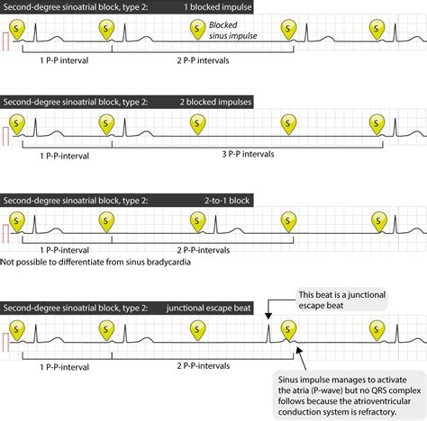 Sinoatrial Block Sa Block Ecg Criteria Causes And Clinical Features Ecg Learning