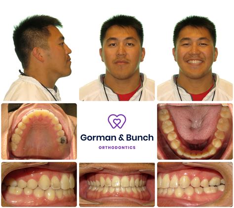 Invisalign Before And After Stories With Our Patients Gorman And