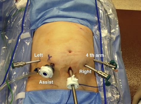 Robot Assisted Laparoscopic Retroperitoneal Lymph Node Dissection For
