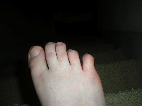 He does not speak for any. Driggers Diggs: Broken toe