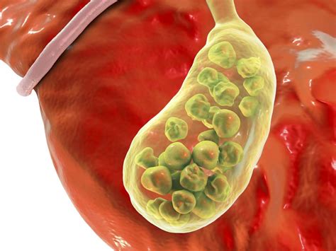 Gallbladder Inflammation Symptoms Signs Complications And Causes