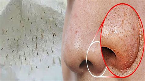 Do This To Remove Blackheads From Your Nose How To Remove Blackheads