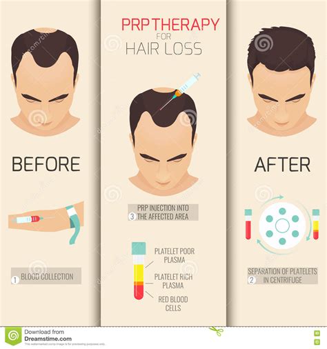 Alopecia is a pathological hair loss. STEPHEN LACSON, MD, FPDS