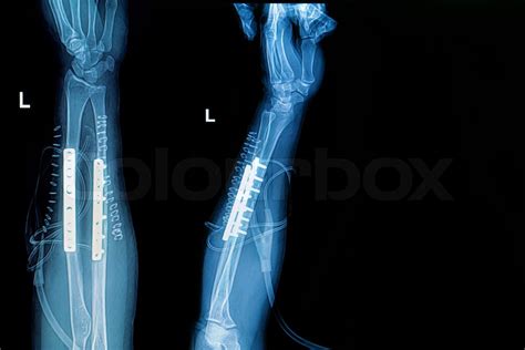 X Ray Image Of Forearm With Implant Plate And Screw Stock Image
